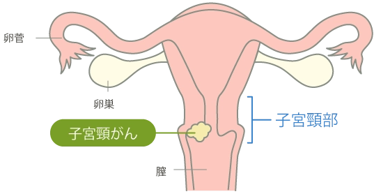 子宮頸がん