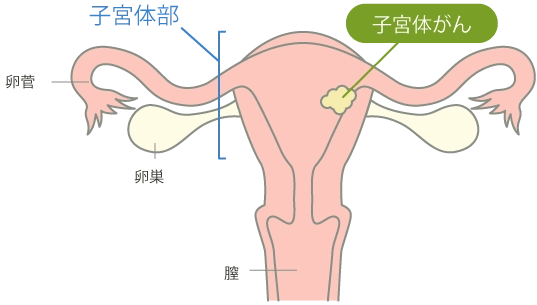 子宮体がん