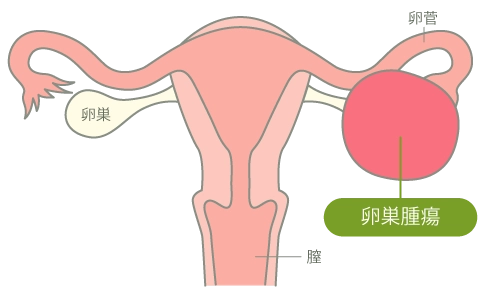 卵巣腫瘍（卵巣のう腫）