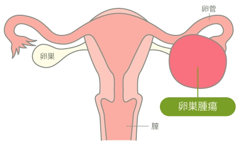 卵巣腫瘍(卵巣のう腫)