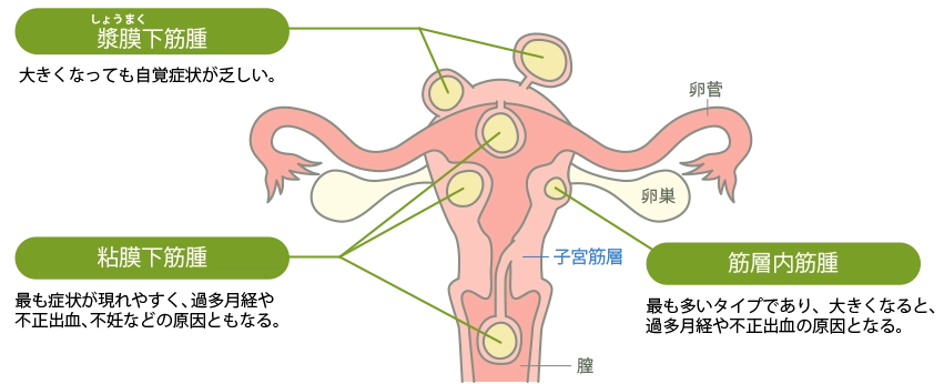 子宮筋腫