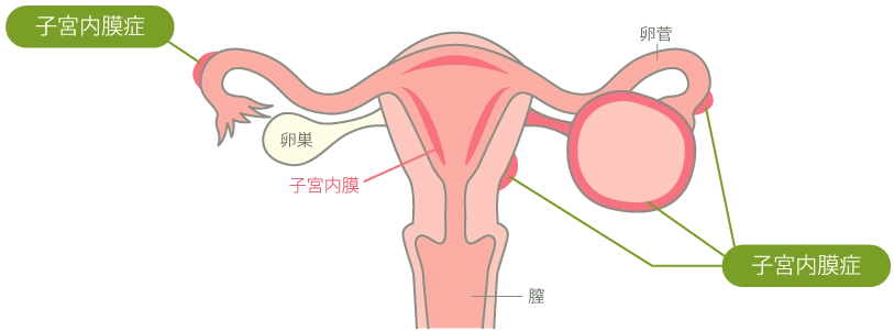 子宮内膜症